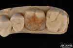 Custom Compound Inlay Onlay For Minimally Invasive Dental Restoration