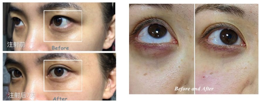 Anti Wrinkle Facial Dermal Fillers For Removing Eyes Circle Tear Grooves