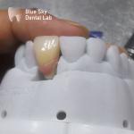 Regular Implant Cases Universal Compatibility Dental Implant Case