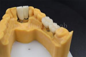 Wholesale Customizable Dental Restoration Implant Crown Replacement Various Sizes from china suppliers