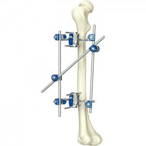 Wholesale Excellent Quality Instrument Orthopedic Tibia & Percone External Fixator Orthopedic Surgical Instruments from china suppliers