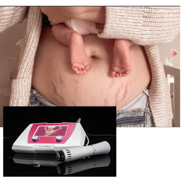 Cellulite Treatment Acoustic Shockwave Therapy Device Shock Wave Cellulite