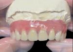 Titanium implant supported Bar Attachment Dentures from china dental lab