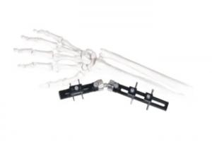 Wholesale Straight Pin Type Wrist Medical External Fixator minimal interference with soft-tissue from china suppliers