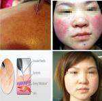 2015 best Seller!!! home removal veins