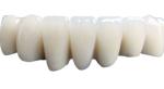 Porcelain Dental Crown Realistic Appearance Confident And Beautiful Color Stable