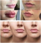 Hyaluronic Acid Wrinkle Injection Fillers HA Face Breast Buttock Filler