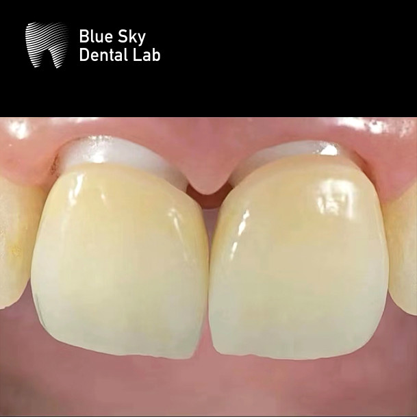 Aesthetic Zirconia Abutment Implant Biocompatible Precision Milled