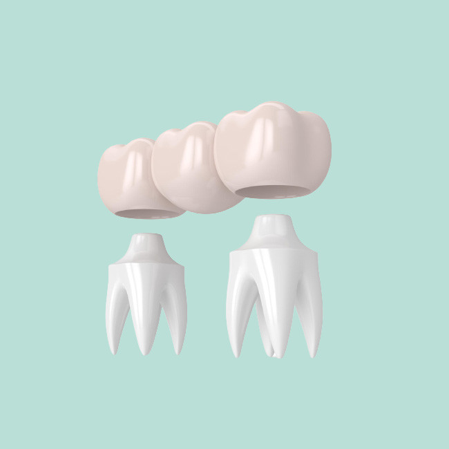 Healthy Dental Crown Bridge High Strength And Make The Smile More Beautiful