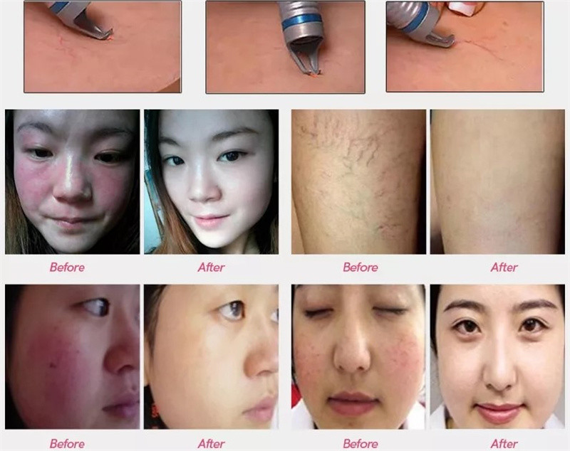 980nm Diode Laser Spider Vein Removal Machine Nail Fungus Treatment