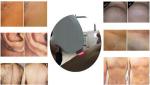 High Quality Manufacture Laser Hair Removal 808nm Diode Laser Hair Removal