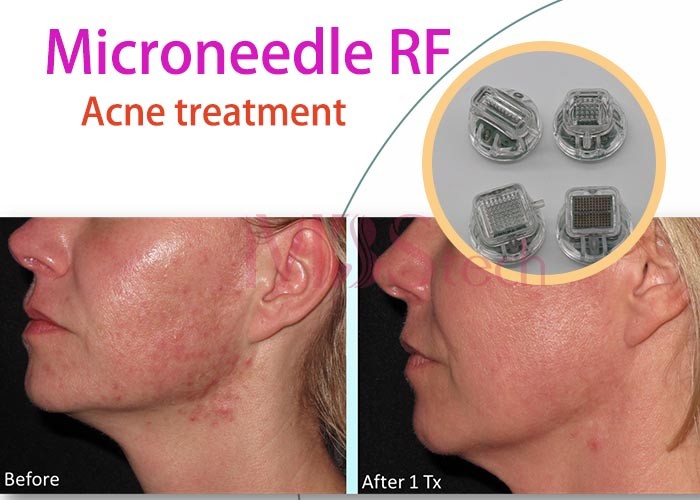 Vacuum Fractional Rf Microneedle Machine For Acne Scars