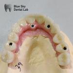 Universal Dental Implant Case Compatible With Multiple Implant Systems