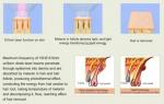 808nm Diode Laser Hair Removal Equipment For Permanent Hair Removal