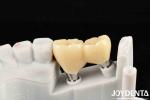 Experience Aesthetically Pleasing Results With Customizable Implant Retained