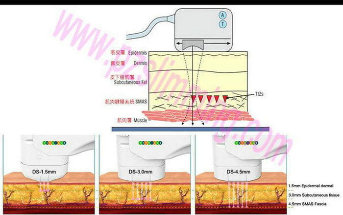 2015 Best hifu sound for skin tighten and face lift
