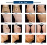 Anti Puffiness Endosphere Cellulite Roller Butt Slimming Vacuum Machine For
