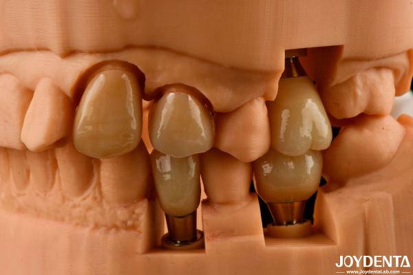 Customizable Implant Crown and Bridge Achieve a Natural Look with Long-lasting
