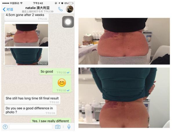 New Arrival Vertical Cryolipolysis for Weight Loss Fat Removal Cellulite Machine