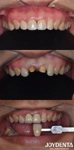 Wholesale Biologically Oriented Preparation Technique Dental vertical Preparation Minimally Invasive from china suppliers