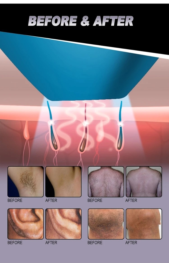 Ice Speed L 3 Wavelength Oem Commercial 808 Diode Laser Hair Removal Machine