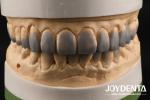 Highly Accurate Temporary Dental Diagnostic Wax Up Customized 1-2mm Thickness