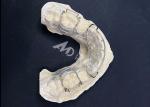 Hawley retainer Orthodontic Appliances for Comfortable Teeth Alignment