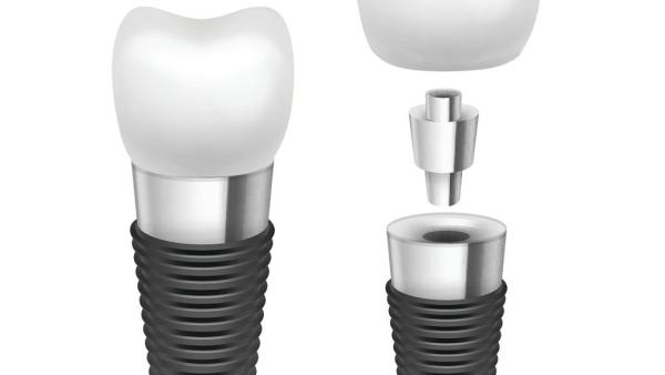 Titanium / Cobalt Chromium Dental Implant Rod Comfortable Highly Biocompatible