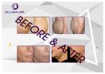 2D / 3D Hifu Ultrasound Machine In Smas Anti Wrinkle Face Lift / Cellulite