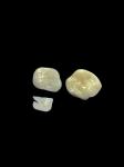 Hypoallergenic Porcelain Inlays Onlays for Teeth Repair Natural Color and Easy