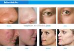 H2o2 Hydrogen Skin Rejuvenation Machine RF Micro Bubble Beauty