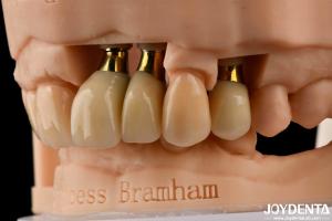 Wholesale Precision Dental Implant Crown and Bridge Perfect Solution for Aesthetically Pleasing Smile from china suppliers
