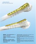 Titanium SS Distal Radius Fracture Plate Orthopedic Implants Plates