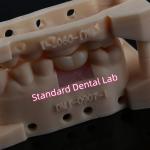 Custom Abutment Implant Crown Full Contour Zirconia Screw Retained