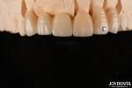 CAD / CAM Milling Dental Layered Zirconia For Single Crowns 0.3-0.5mm Layer