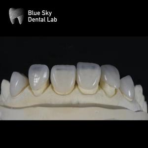 Wholesale Ultra Thin Sleek Veneer Cases 0.3mm Thinnest Custom Veneers from china suppliers