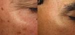 Home Nd YAG Medical Laser Beauty Machine For Weight Loss / Skin Tightening