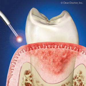 Teeth Whitening Dental Diode Laser 10W 980nm Soft Tissue Lasers In Dentistry