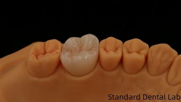 Noritake Porcelain Full Contour Zirconia Crown Customized Vita Shade for