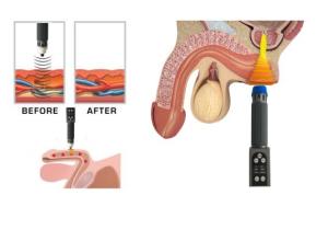 Wholesale Clinic Use Dual Channel Acoustic ESWT Therapy Machine For Full Body Massage ED Treatment from china suppliers