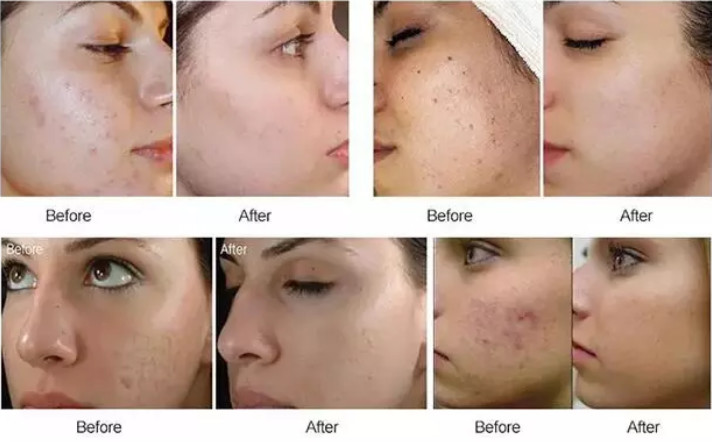 Transparent Anti Aging Mesotherapy Solution Colorless