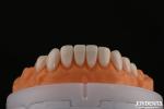 A1-A4 Ips Emax Press Porcelain Dental Veneers Stain Resistant Customizable Shape