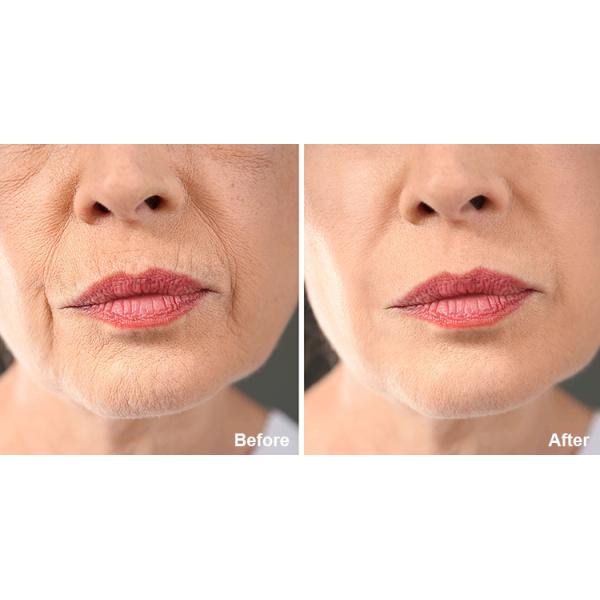 Professional 40.68Mhz Rf Face Lifting Machine Wrinkle Remove 40.68Mhz