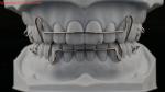 Comfortable Stainless Steel Acrylic Hawley Retainer Effective Orthodontics