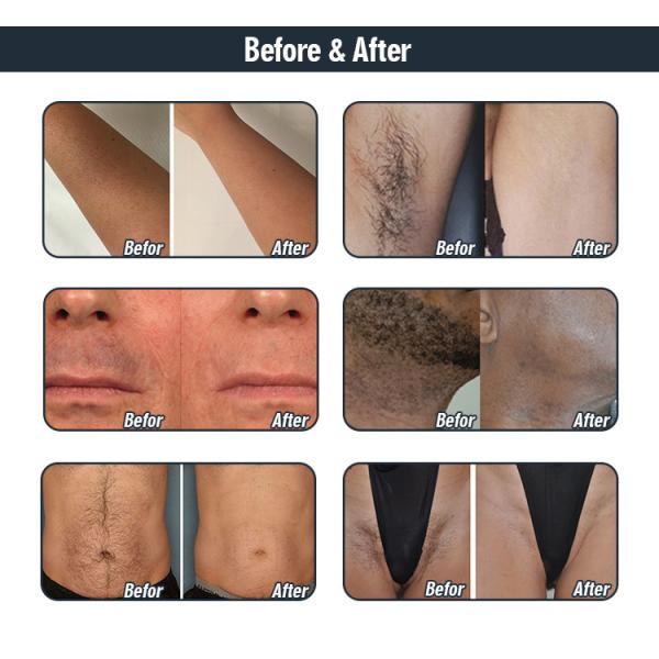 1200W Handpiece Power Diode Laser Hair Machine For Permanent Hair Reduction