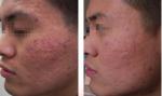 High Quality Fractional RF Microneedle for skin tighting and skin rejuvernation