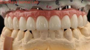 Wholesale Porcelain All On Four Zirconia Bridge High Esthetics Dental Implant Bridge Screw Retained from china suppliers