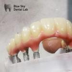 Compatibility Implant Cases Regular Implant System Dental Cases