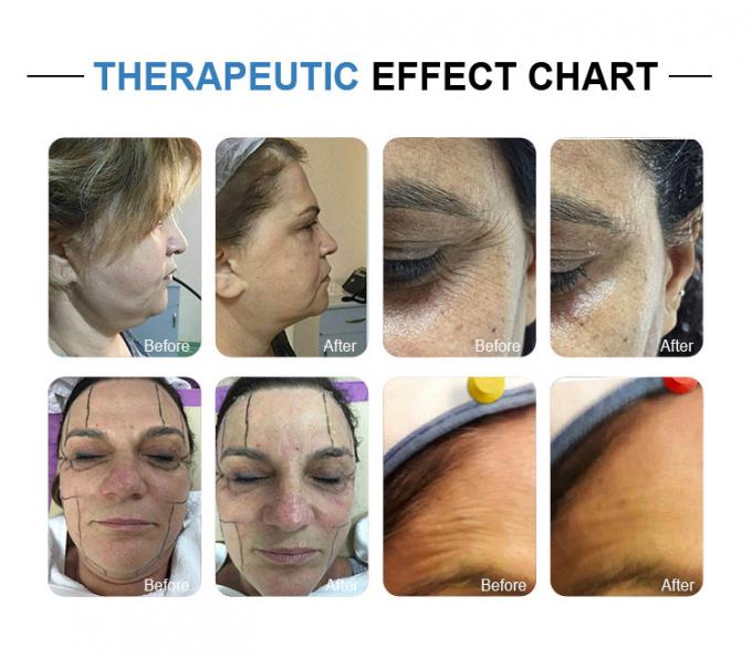 HONKON HIFU Machine Facial Wrinkle Removal High Intensity Focused Ultrasound 1