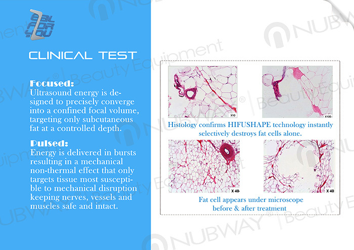 HIFU clinical test.jpg